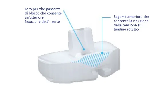 Revisione Evolution® – Femore CCK Photo 4 1