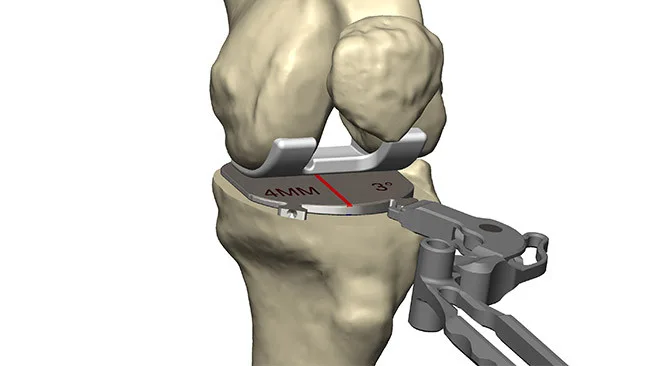 Prophecy®-Gap Balancing Prophecy gap balancing instruments tibia gap 1