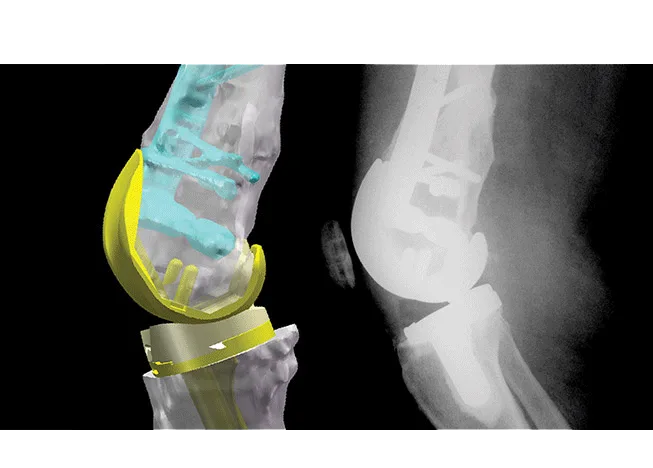 Prophecy® Prophecy Nav Guidelines knee x ray 1